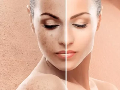 Biostimolazione