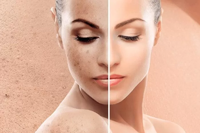 Biostimolazione Biostimolazione