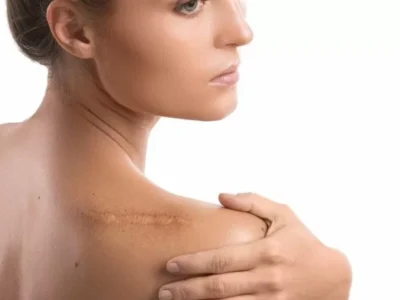 Cicatrici